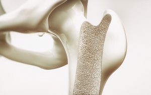 3D-Darstellung eines Querschnitts durch den Oberschenkelknochen mit sichtbarer schwammartiger Knochenstruktur.