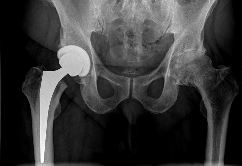 Röntgenaufnahme des Beckens und der Hüften, zeigt eine künstliche Hüftprothese im linken Hüftgelenk. Die rechte Hüfte ohne Prothese zeigt natürliche Knochenstrukturen.