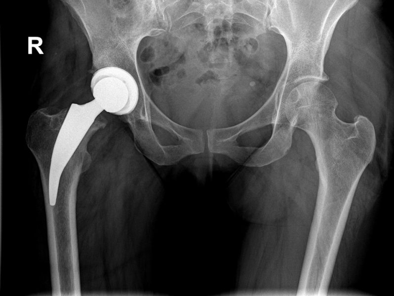 Röntgenaufnahme zeigt eine Hüftprothese im rechten Hüftgelenk eines Patienten. Die linke Hüfte ist ohne Prothese und zeigt normale anatomische Strukturen.