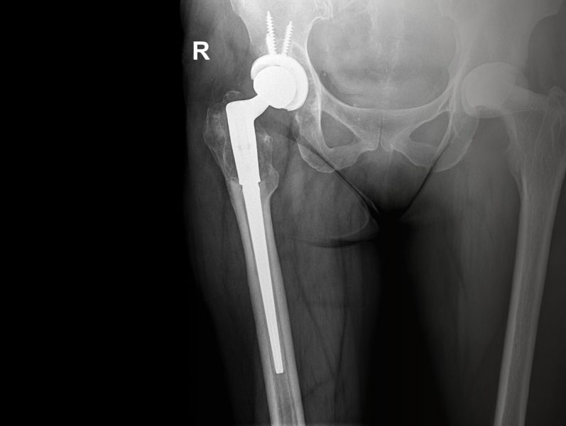 Röntgenaufnahme des Beckens und der Oberschenkel, die eine rechtsseitige Hüftprothese zeigt. Man erkennt eine metallische Prothese im rechten Oberschenkelknochen und Hüftgelenk, markiert mit einem "R" für rechts.