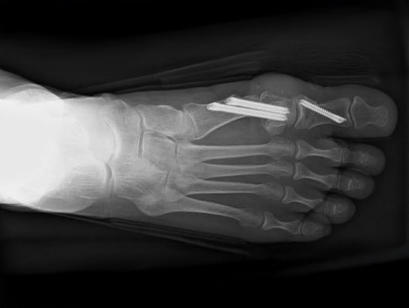 Röntgenaufnahme eines menschlichen Fußes mit zwei chirurgischen Schrauben im Bereich des Mittelfußknochens.