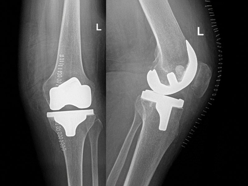 Zwei Röntgenaufnahmen eines linken Knies. Links zeigt die Aufnahme eine Knie-Totalendoprothese mit sichtbaren Metall- und Kunststoffkomponenten. Rechts ist eine komplexe Prothese mit zusätzlichen Stützstrukturen zu sehen.