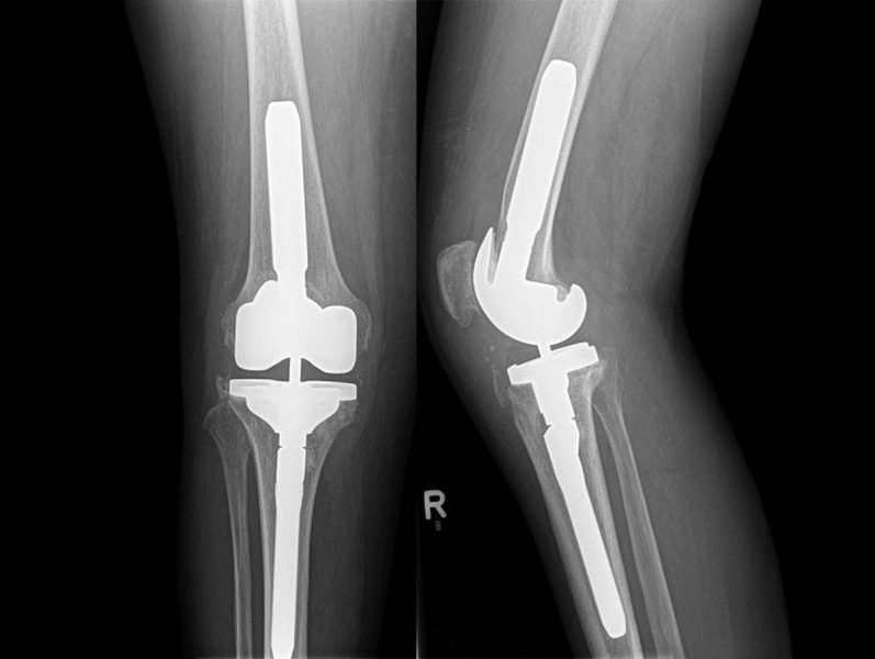 Röntgenbilder eines rechten Knies von vorne und von der Seite, die eine Kniegelenkprothese zeigen. Die Prothese besteht aus Metallkomponenten, die den Oberschenkelknochen, das Schienbein und das Kniegelenk ersetzen.