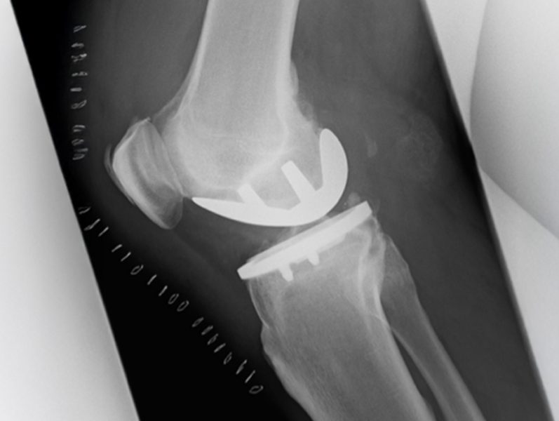 Röntgenaufnahme eines menschlichen Knies mit einem implantierten künstlichen Kniegelenk, das die Knochenstrukturen und das Implantat zeigt.