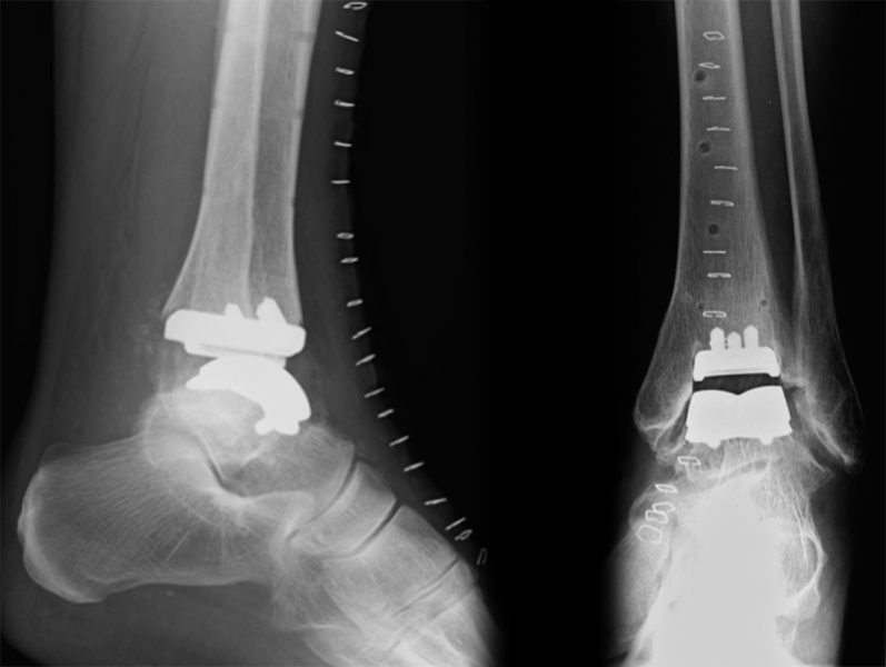 Zwei Röntgenaufnahmen eines menschlichen Fußes mit einem Knöchelimplantat. Links zeigt das Bild den Fuß von der Seite, rechts von vorne, beide mit sichtbaren Metallstrukturen des Implantats.