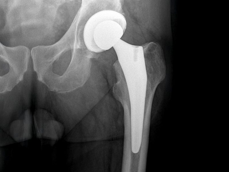 Röntgenaufnahme, die eine künstliche Hüftprothese zeigt. Die Prothese besteht aus einem kugelförmigen Gelenkkopf und einem langen Schaft, der in den Oberschenkelknochen eingeführt ist.